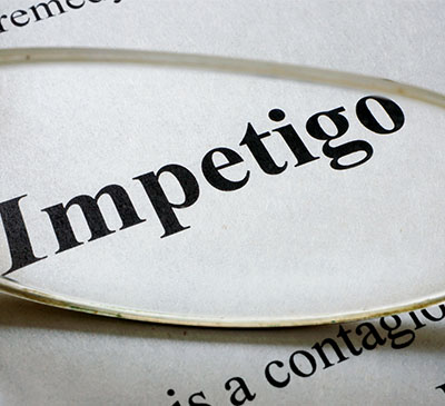 Global Impetigo Drugs Market 2019-2023